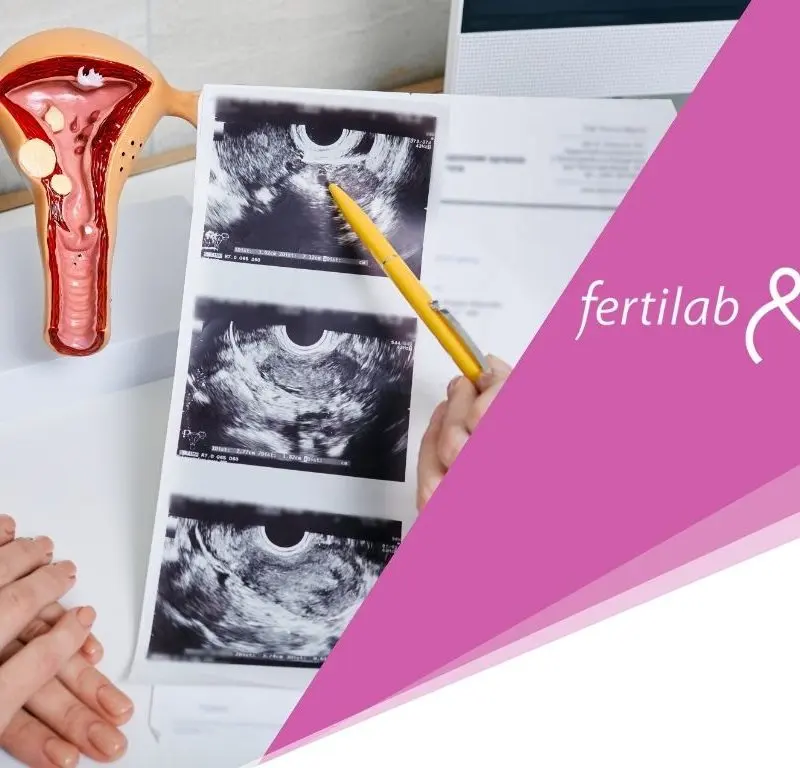 ¿Es posible donar óvulos con ovarios poliquísticos?